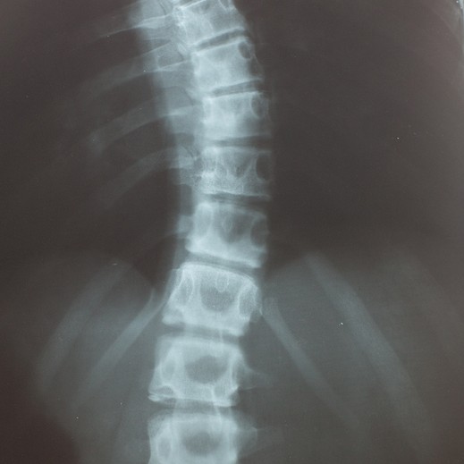 Scoliosis